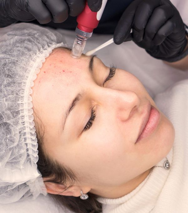 Expert Microneedling